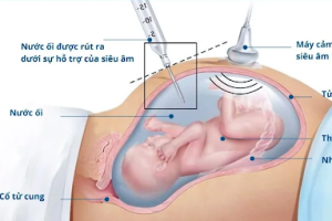 CHỌC ỐI ĐƯỢC THỰC HIỆN NHƯ THẾ NÀO? CÓ CẦN THIẾT KHÔNG?